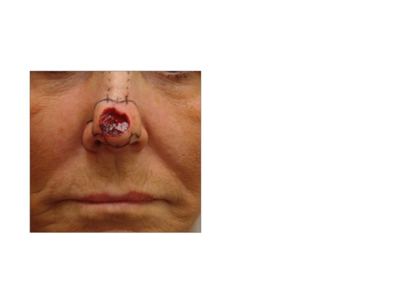 Skin Cancer Facial Reconstruction
