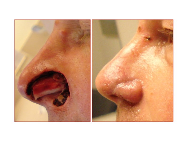 Skin Cancer Facial Reconstruction