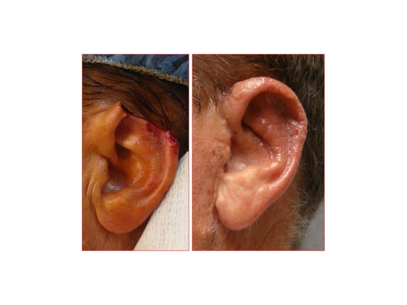 Skin Cancer Facial Reconstruction