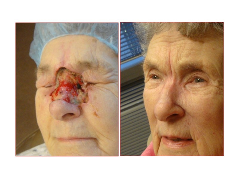 Skin Cancer Facial Reconstruction