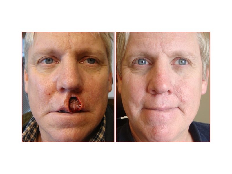 Skin Cancer Facial Reconstruction
